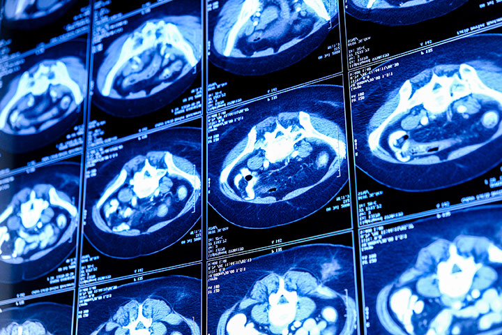 Maladies du foie : SoQut Imaging ouvre son capital